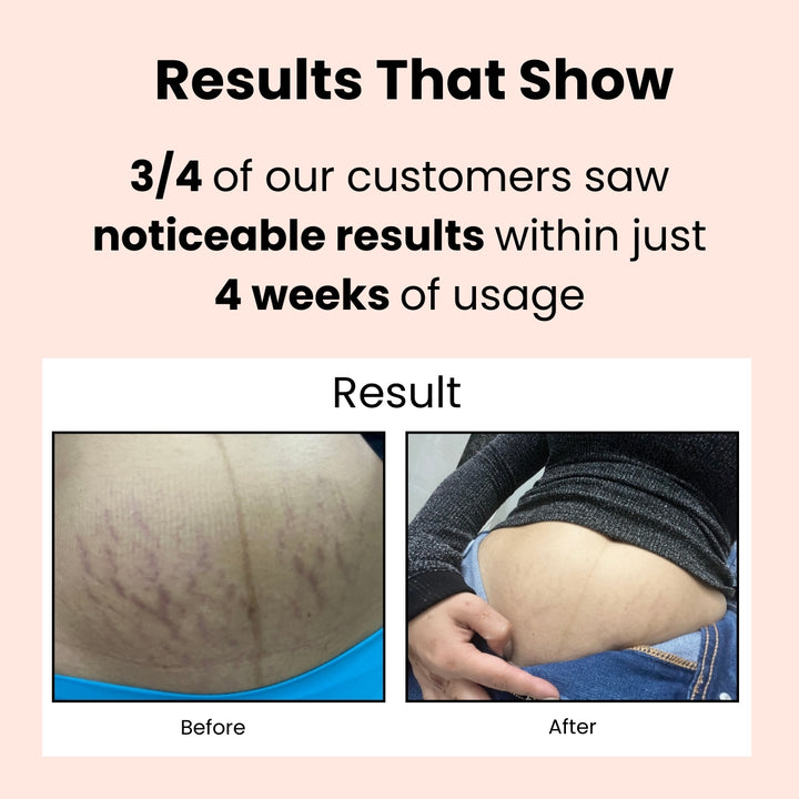 Belly Oil for Pregnancy
