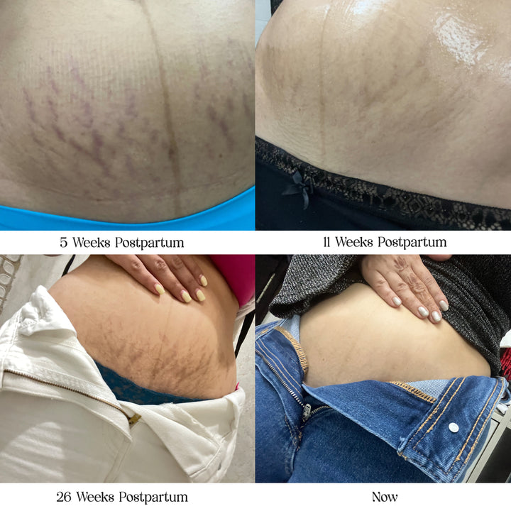 Best Stretch Mark Removal Oil